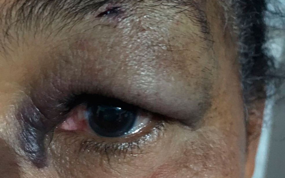 Idosa ficou com o olho esquerdo após ser agredida por vendedor ambulante na Bahia (Foto: Arquivo Pessoal)