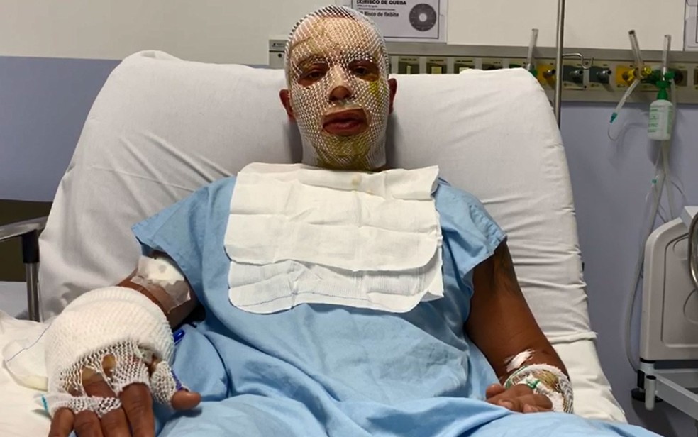 Rogério Lins, prefeito de Osasco, se recupera de acidente com fogueira em festa junina â?? Foto: Divulgação/Prefeitura de Osasco