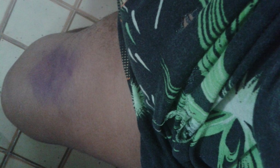 VÃ­tima mostra lesÃ£o na perna apÃ³s ataque  â?? Foto: Arquivo Pessoal 