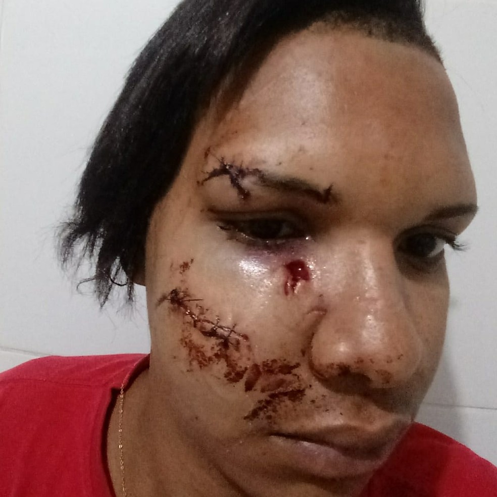 Jackson no dia em que o homem quebrou o copo na cabeÃ§a dele, em Juazeiro â?? Foto: Arquivo Pessoal
