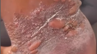 Queimaduras Rondesp